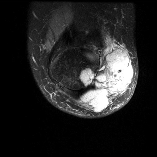 Figure 2 for case synovial sarcoma ( RID4558 )